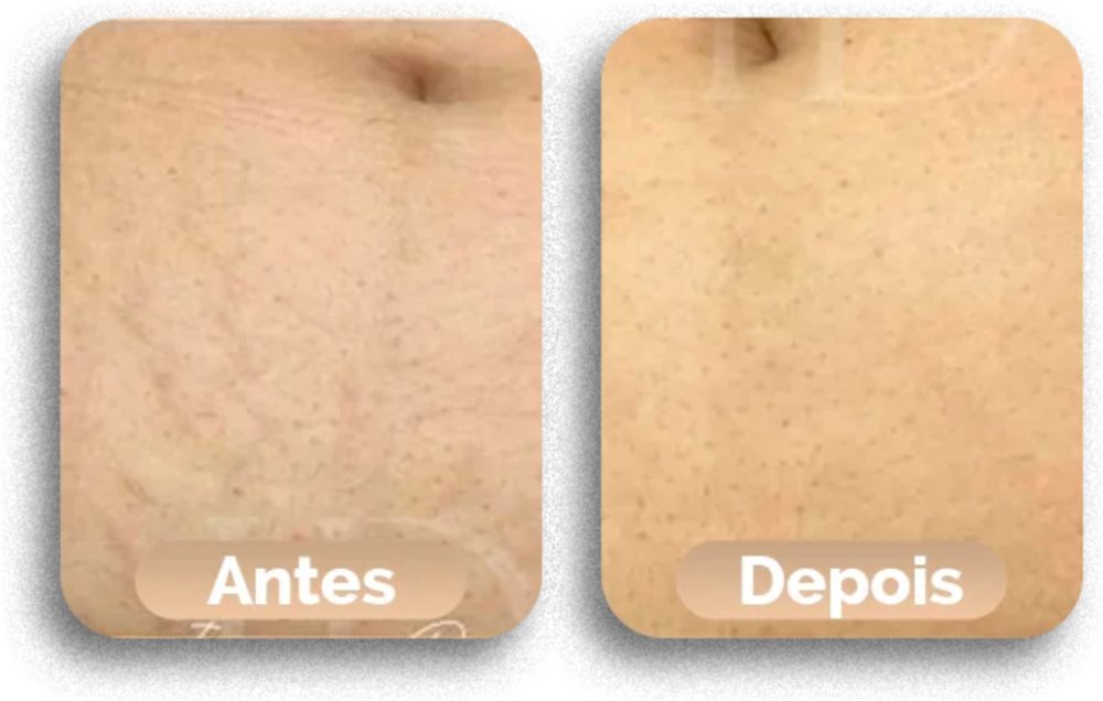 Antes e depois do tratamento de estrias, caso 1