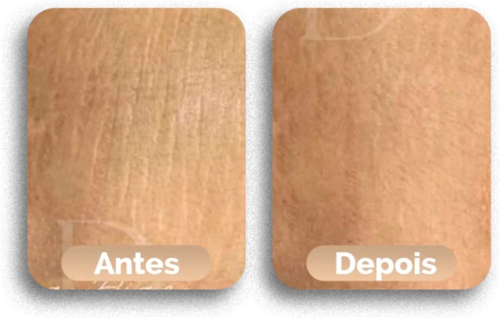 Antes e depois do tratamento de estrias, caso 2