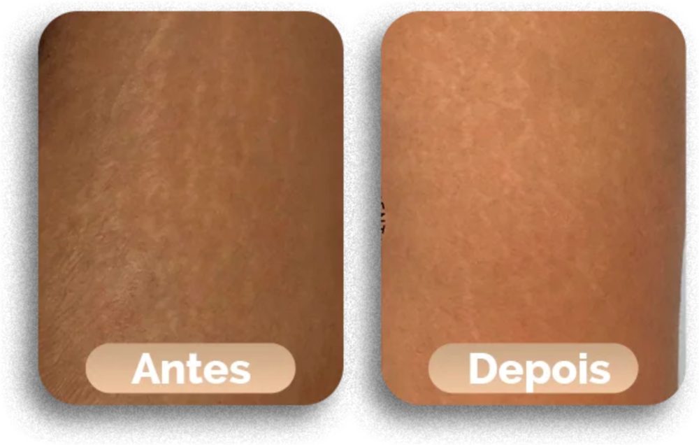 Antes e depois do tratamento de estrias, caso 3