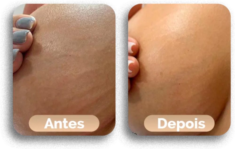 Antes e depois do tratamento de estrias, caso 4